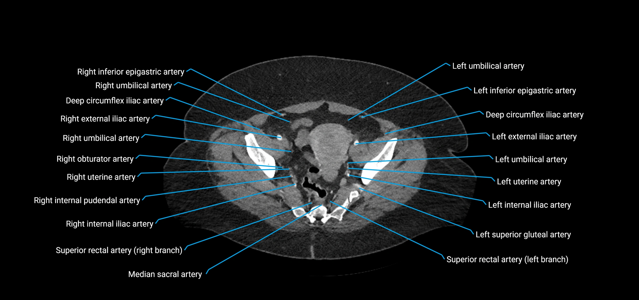 CTA abdomen axial cross sectional anatomy labelled image_215 (2).webp